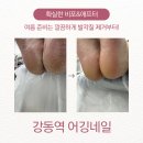 네일4032 | 강동역 어깅네일 굳은살 많은 여자의 여름준비 발각질 제거 대만족 후기