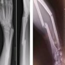 원위요골과 척골골절 (Fracture Of Distal Radiius And Ulna) 이미지