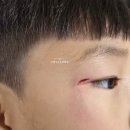 아이 눈끝 찢어짐 봉합 후기｜주말 밤 부산 케이성형외과 다녀온 기록