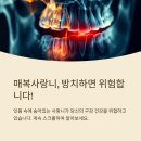천안신부동치과 매복사랑니발치