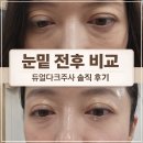 디자인써클 - 은평구 진관3로 32 | 눈밑지방재배치 고민하다 선택한 듀얼다크주사(눈밑다크써클주사) 후기