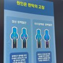 누가의원 다리 붓기 하지정맥 진료후기