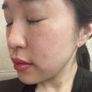 역삼2 | 역삼역피부과, 쥬베륙 후기 2주차후기 (feat. 내돈내산)솔직리뷰