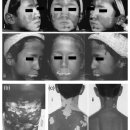 2008년 어린이 백반증 환자에 대한 가성카탈라제 연구결과 이미지