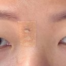 마음모아한의원 | 내 돈 내산 대상포진 흉터 치료 새살침 로담한의원 2