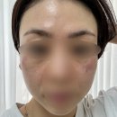 크로커다일(여성) 포천지점 | [ 비비드엘 양주옥정점 ] _ 양주 옥정 기미관리 받고 효과본 에스테틱 다녀왔어요!