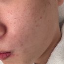 정안약국 | 모낭염 여드름 약국 연고 라미실로 박멸 도전하기(2)