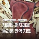 감초한의원 | 저혈압 어지러움 치료 되나요?성수동 한의원 3주 한약 후기