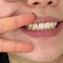 치아사랑 | [치아미백후기] 라울루 화이트솔루션 플러스투 치약 사용후기!