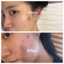 피부사랑 | [대구 피부관리/윤곽관리] ‘라임피부사랑’에서 여드름 박멸한 후기