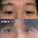 드라마성형외과의원 | 드라마성형외과 | 이승국 원장님 남자 비절개 눈매교정 쌍수 앞트임 상담, 수술 6개월차 후기