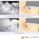 동탄 사랑니 매복 케이스도 당일 발치 이미지