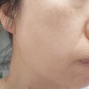 알파안산 | 듀얼소닉 프로페셔널 알파 한달후기ㅣ효과 전후 사진O 카트리지 사용법