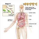 대장암1기와 대장암2기 차이점! 이미지