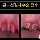 코골이 양압기 효과 처방 검사 단점 교정 치료 구의동치과