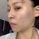 잘도 | 부산 서면 티타늄리프팅 잘 하는 곳 내돈내산 후기