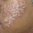 더레드피부과의원 | 더 레드 피부과 여드름 흉터 2회차 일주일 후기