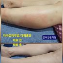 [피부질환/자극성피부염.다형홍반] 치료 전후 사진 이미지