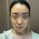 잡티제거피부과 색소치료 후기｜프락셀레이저 + 인라이튼레이저+압출관리 2주 변화 강추 조합