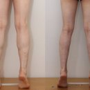 디자인유어바디(Design Your Body) | 제17편: 보톡스 내성 방지 전략과 치료 - "종아리근육뭉침, 오다리교정, 다리부종병원, 종아리마사지...