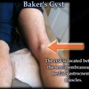 baker's cyst 베이커스 낭종 이미지