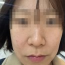 육층한의원 | 역삼동 강남역 피부과, 연어주사 여드름스킨부스터 내돈내-산 후기, 효과