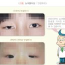 눈꺼풀처짐 남자여자 안검하수와 안검내반 수술에 대하여 이미지