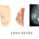 유방결절 : 혹 멍울 낭종 물혹 양성석회화 섬유선종 통증 문제는 이미지