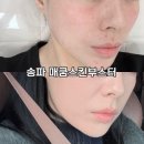 한불피부이야기 | [송파] 예신 준비로 모공, 피부 결 개선에 빠른 효과 매쿰시술 후기