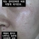 20-C | 졸로픽스 민타비20 앰플 논크림 후기 고순도비타민C 20%강력미백효과