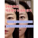 [내돈내산] 청라 약손명가 15회차 후기! 옆광대 변화로 캡모자 핏이 달라졌어요