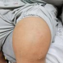 무릎 수술전 셀로비스 콘드로이친 섭취 후기
