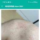 동의보감한약국 | 과로와 운동뒤 발생한 피부염. 가려움. 피로. 근육 관절 뻐근통. 다리당김에