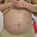 김정문알로에 오금점 | 임신소양증 6개월째.. 광선치료 부작용 조심