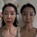 늘편한유항외과의원 | 셀리닉의원에서 윤곽볼륨과 주름개선을 위한 볼륨셀 2주차 후기
