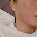 온다리프팅 가격 후기 통증 다운타임 강남피부과