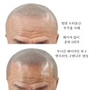 7513 | 광명.안양.산본.군포.새솔동.동탄.광교.인천.송도.천안.대전.화성.일산.성남 부분탈모 두피smp학원수강