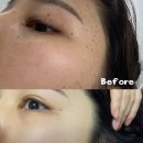 서면한의원 | 부산 서면한의원 편평사마귀 제거 후기