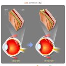 이룸보청기 | 간호사 &amp; 간호조무사 시험에 나오는 대비 성인간호학 필수 요점 정리 11. 감각계