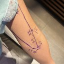 연세고은의원 | 혈액투석 전 동정맥루 수술 후기 – 이담외과의원에서 받은 수면마취 시술 이야기