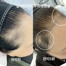 레인솔루션 | 인하대역탈모, 넓은 이마 고민이라면? 학익동탈모관리 '설레인라인' 솔직 후기