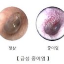 성인 소아 급성 만성 중이염 증상 원인 치료 이미지