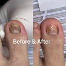 아트메디 | 꼼꼼한 문제성발톱관리 메디앤네일에서 발톱무좀균스케일링 후기