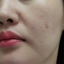 셀트러스트랩 | 과천피부과 모공레이저로 받아본 포텐자 솔직후기