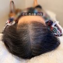 딜리헤어 | 8회 항암 치료 후 멈춘 머리카락 두피생장술 1개월 후기 (60대 여성 정수리탈모)