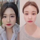 인천송도피부과:) 턱선라인케어 ★미글로우리프팅 후기 및 온다리프팅 차이★