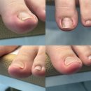 엔피(NP) 운동교육원 | 김해내성발톱 통증 없이 깔끔하게 관리 받은 엔피케어 김해점