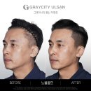 이상헤어 | 울산 헤어라인문신 후기, 이마 넓은 남성의 인상이 달라진 결정적 이유