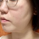 엔킴의원 | 서면 엔킴의원에서 고주파 레이저 리프팅 쿨페이즈 받고왔어요