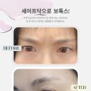 본병원 | 세이프닥으로 강남 보톡스 받아본 내돈내산 후기｜병원 예약 ∙ 할인 어플 솔직 사용기